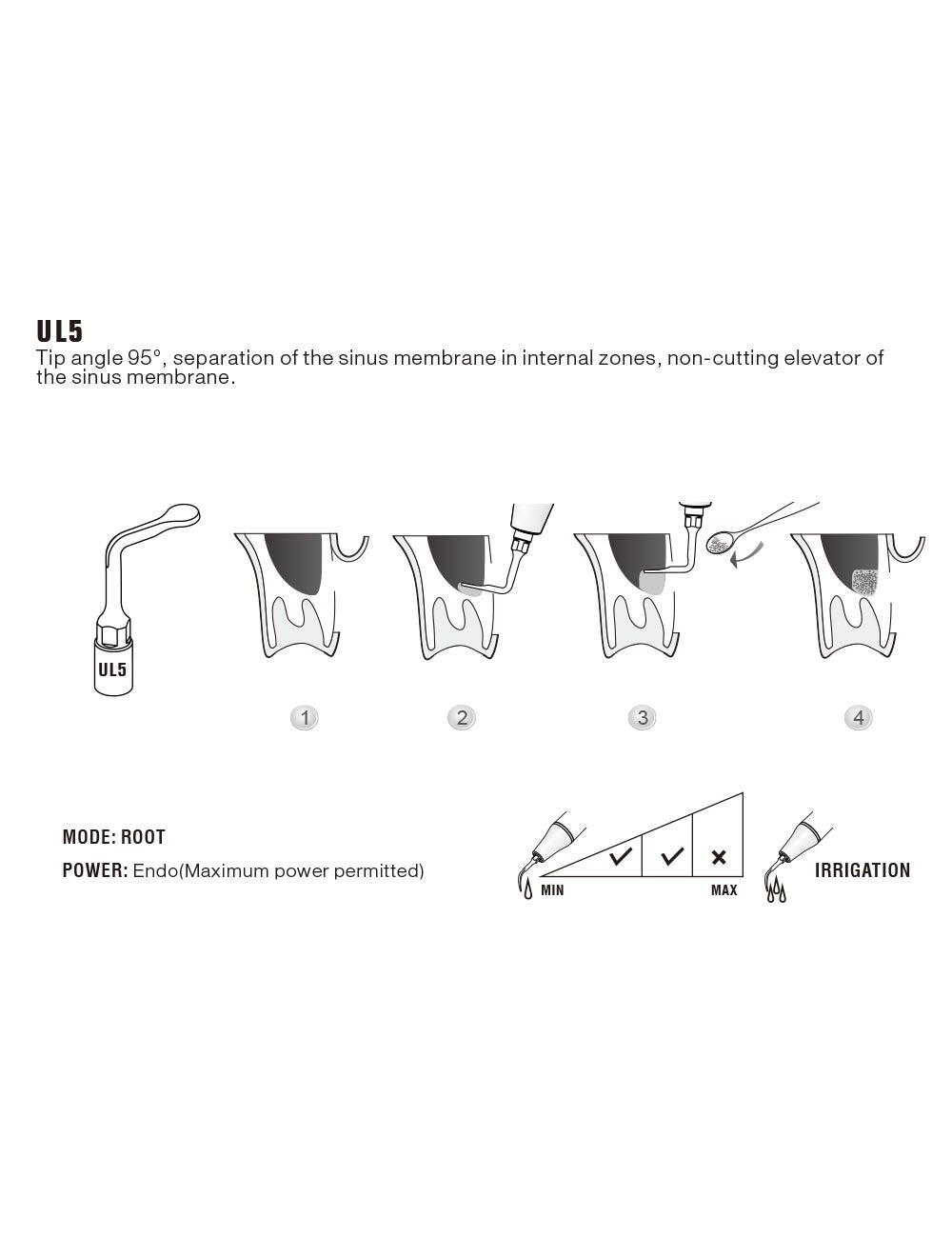 Insert UL5 pour chirurgie piezo - WOODPECKER - uofti.com