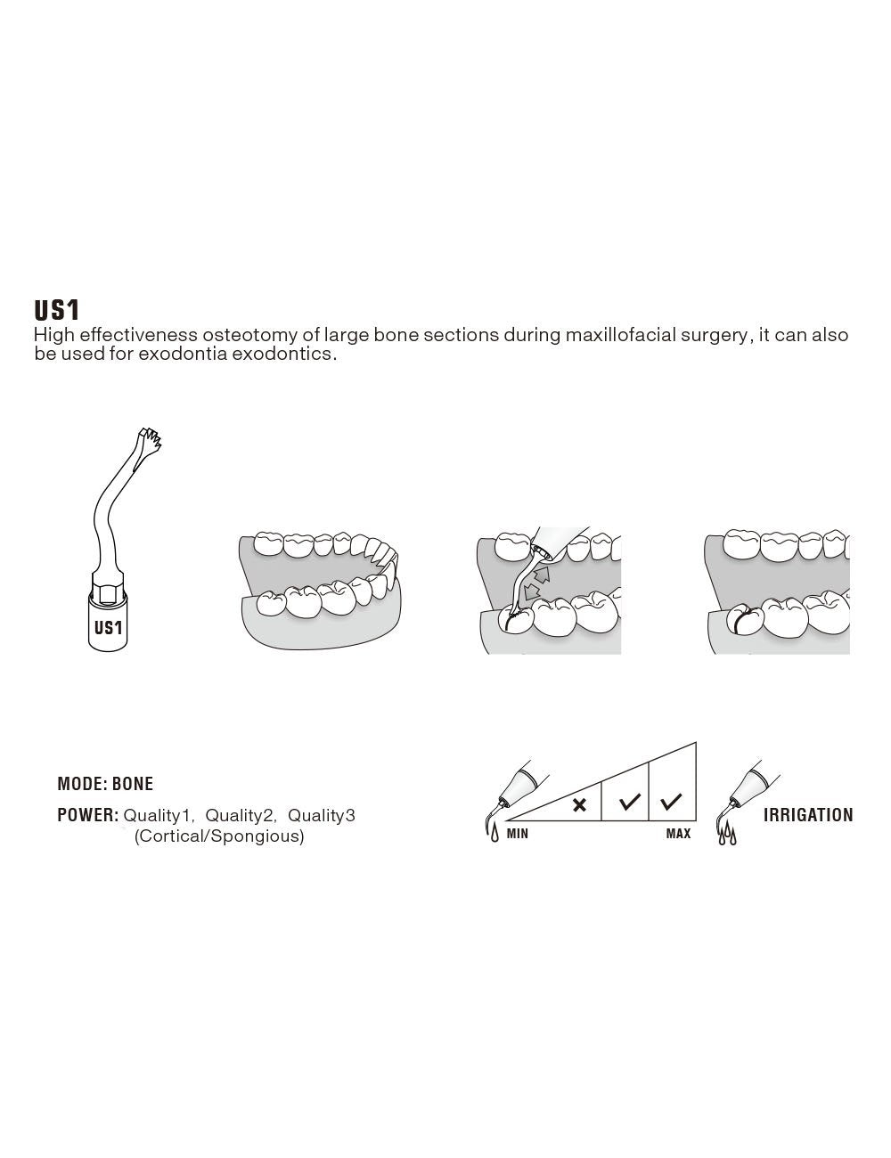 Insert US1 pour chirurgie piezo - WOODPECKER - uofti.com