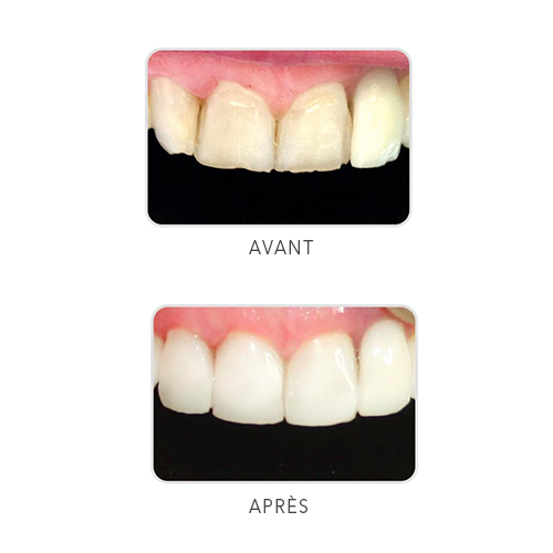 Uveneer Moules pour élaboration de facettes - ULTRADENT - uofti.com