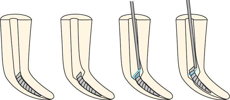 SOS Endodontiefeile