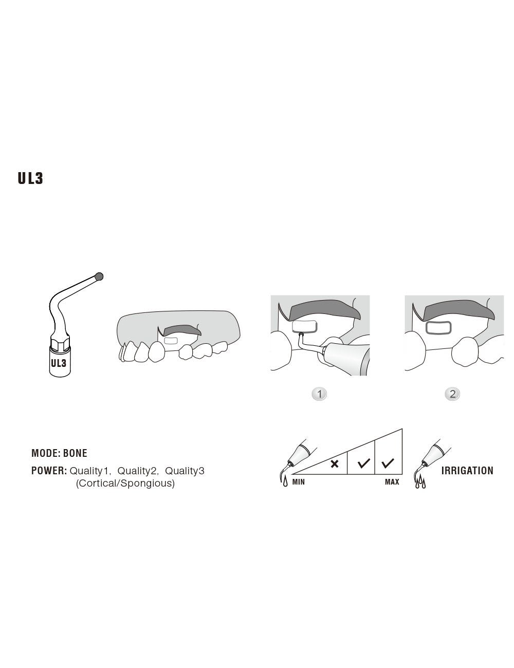 Insert UL3 pour chirurgie piezo - WOODPECKER - uofti.com