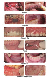 MATBEKA intra-oral boîte 20 pansements (25x15mm) - uofti.com