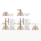 SOS Kit - Extraction rapide & sécurisée de vis d’implant cassées par Safe Implant - uofti.com