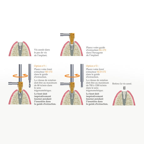SOS Kit - Extraction rapide & sécurisée de vis d’implant cassées par Safe Implant - uofti.com