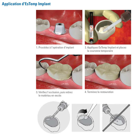 EsTemp Implant 1x 8g Ciment temporaire à base de résine sans eugénol pour les couronnes retenues par implants - uofti.com