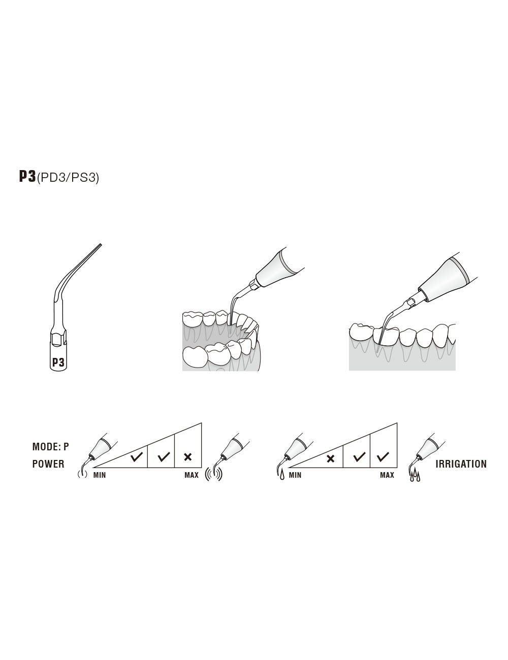 Insert PD3 compatible Satelec - WOODPECKER - uofti.com