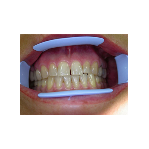 Optiview Ecarteur labial et jugal - Kerr - uofti.com