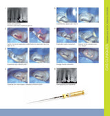 Lot de 6 limes One G NiTi de cathétérisme en rotation continue MicroMega - Dental Coop