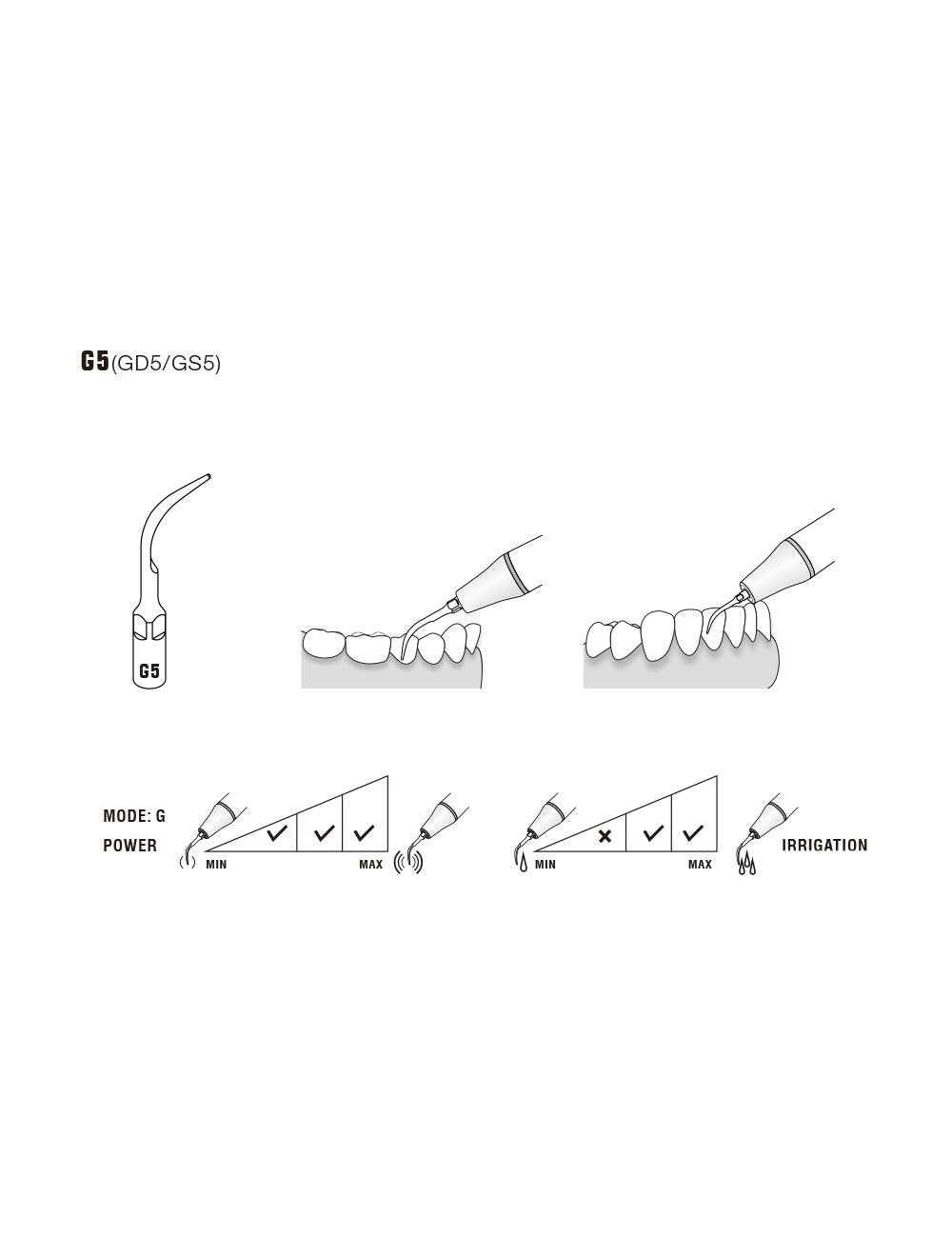 Insert GD5 compatible Satelec  ultrarésistant UR - WOODPECKER - uofti.com