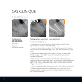 Lot de 6 limes One Curve - 6% conicité MicroMega - Dental Coop