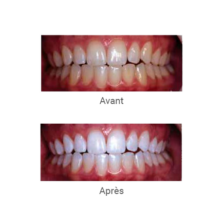 Opalescence BOOST Blanchiment dentaire - uofti.com