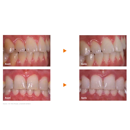 Perfect Bleach Blanchiment dentaire - VOCO - uofti.com