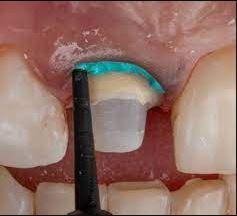 Retraction Paste - Pasta astringente para la retracción gingival temporal - VOCO