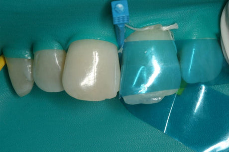 Matrice antérieure galbée offrant une courbure et une hauteur de bande optimales. Epaisseur: 0,5 mm. Hauteur de bande de 6 à 10 mm.  DM Classe I. Fabricant : Garrison Dental Solutions.