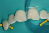 Matrice antérieure galbée offrant une courbure et une hauteur de bande optimales. Epaisseur: 0,5 mm. Hauteur de bande de 6 à 10 mm.  DM Classe I. Fabricant : Garrison Dental Solutions.