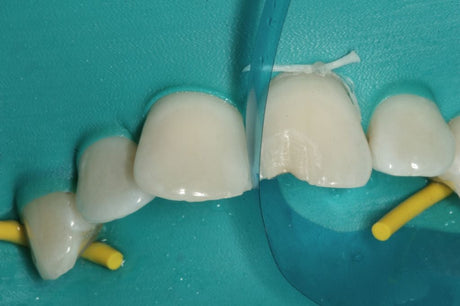 Matrice antérieure galbée offrant une courbure et une hauteur de bande optimales. Epaisseur: 0,5 mm. Hauteur de bande de 6 à 10 mm.  DM Classe I. Fabricant : Garrison Dental Solutions.